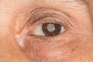 elderly woman with cataracts