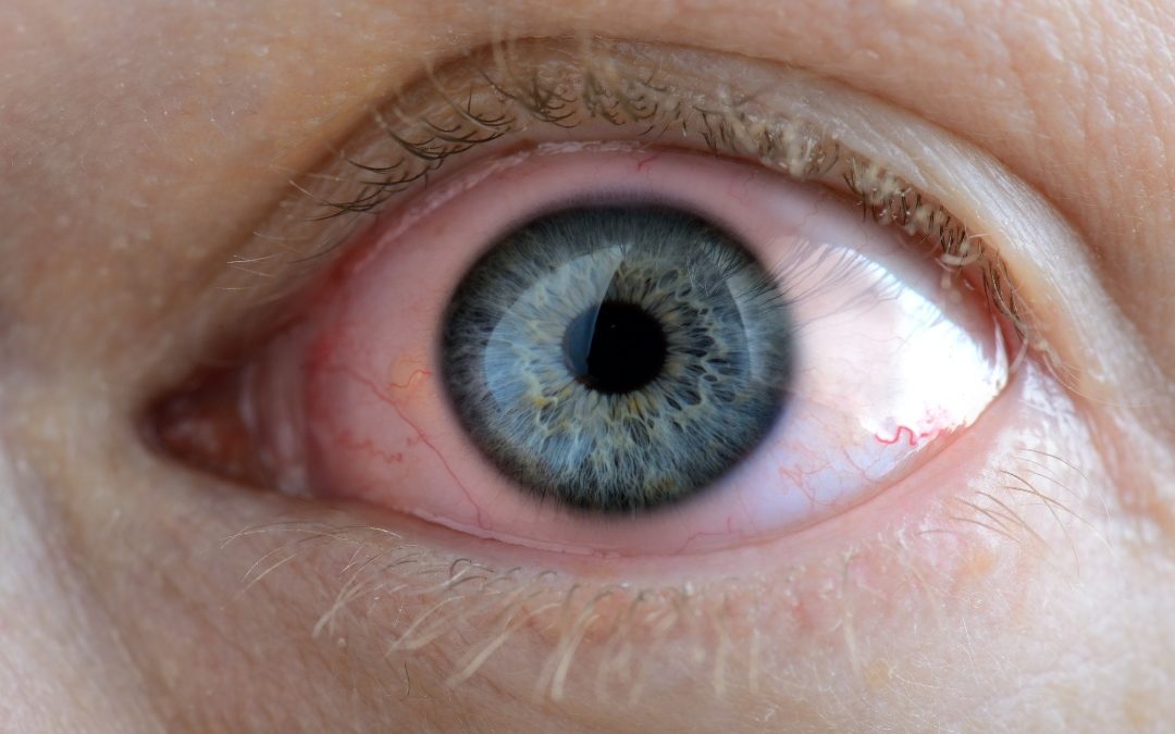 Glaucoma: Why We Give You that Pressure Test